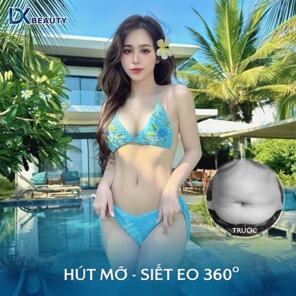 HÚT MỠ